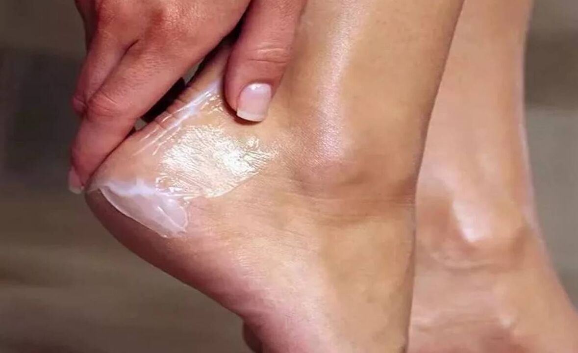 Ako liečiť huby chodidla s Fungent Cream