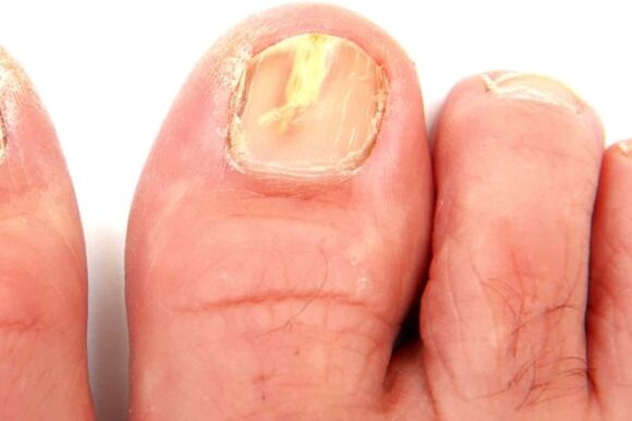 poškodenie nechtovej platničky v dôsledku plesňovej infekcie